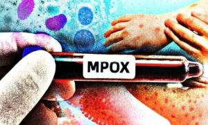 CONFIRMADO: Porto Velho tem quatro casos diagnosticados de Mpox; Sesau alerta para cuidados